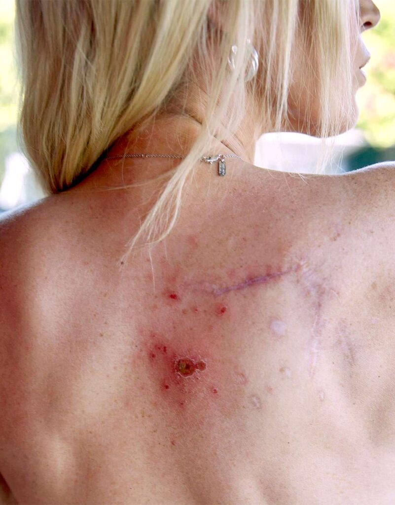 Teddi Mellencamp muestra sus cicatrices tras batalla contra el cáncer 5 Teddi Mellencamp scar 123123 04 8dc3d608cc0c40c689e6fb78f7d3c351