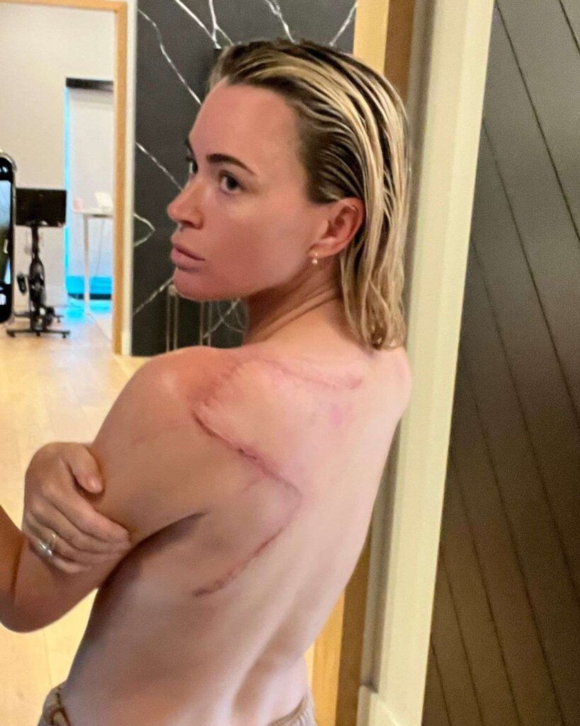 Teddi Mellencamp muestra sus cicatrices tras batalla contra el cáncer 4 teddi mellencamp melanoma gone instagram 011324 1145 695f5b04ddda4d73a851dfda80d0e744